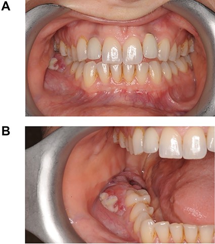 (A) and (B) Photos showing the site of Burkitt’s tumour infiltrating the oral mucosa and extraction site of LR7 prior to incisional biopsies taken by the OMFS team.