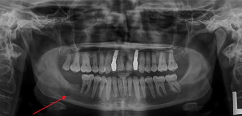 OPG taken on admission to RDH. Note: LR7 has been extracted and there is a patch of radiolucency inferior to LR7/8.