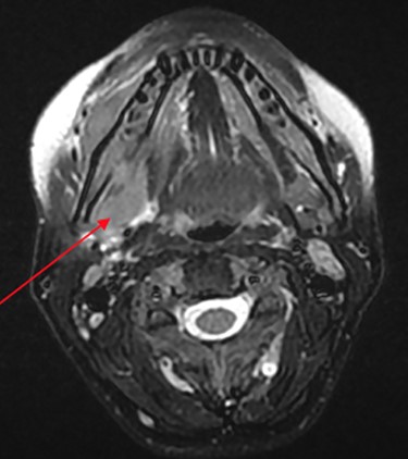 MRI head (axial view) showing Burkitt’s infiltrating the mandible and oral mucosa.