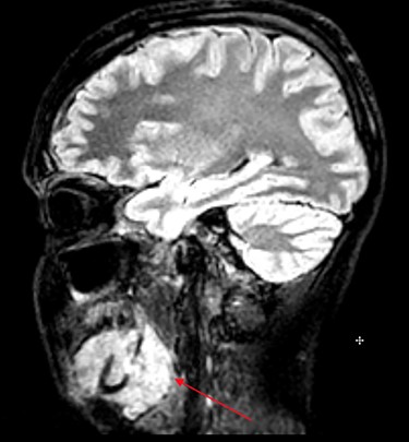 MRI head (sagittal view) showing Burkitt’s infiltrating the mandible and oral mucosa.