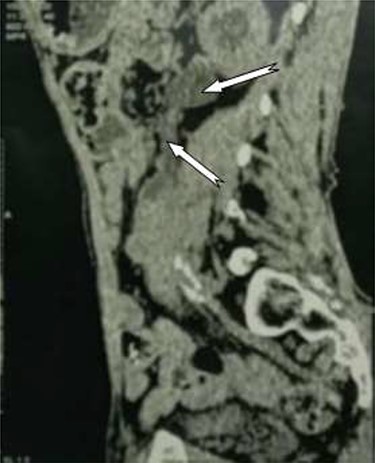 Tumor process at the expense of the kidney and the left urethra.
