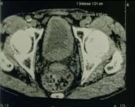 Irregular thickening of the bladder wall.