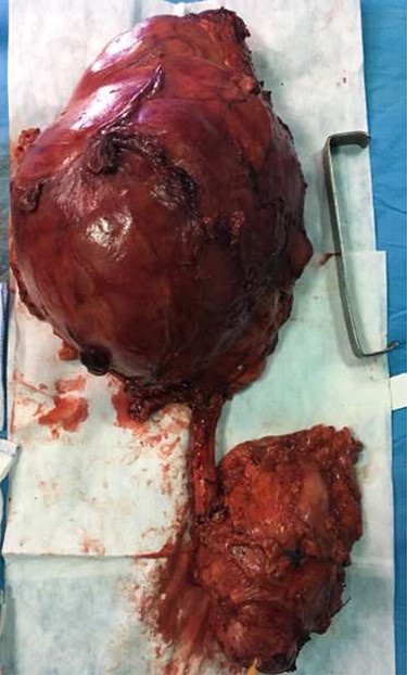 Specimen of right radical nephro-ureterectomy and cystectomy.