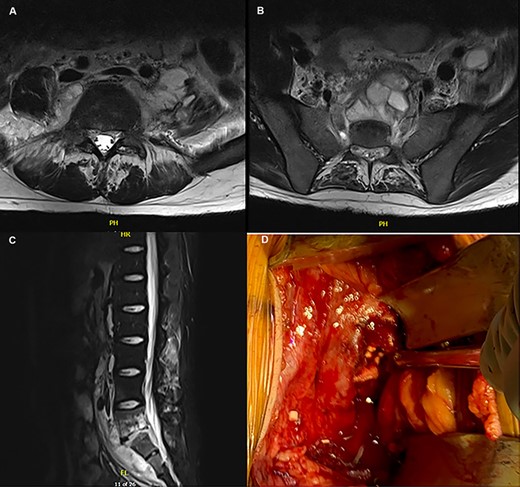 (A–C) MRI depicting the osteomyelitis, discitis and abscess involvement around L5/S1; (D) intraoperative picture of the L5/S1 disc space with placement of tobramycin antibiotic beads.