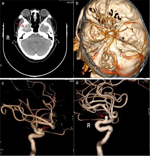 Preoperative imaging. axial CT demonstrated a clear circular shadow with a diameter of ~ 1.9 cm (a). A presurgical CTA revealed small cystic projections in the supra segment of the bilateral internal carotid artery bed process with a uniform diameter of 0.3 cm (b). Presurgical DSA revealed a cystic shadow that was visible in the ophthalmic segment of the right internal carotid artery protruding outside of the vascular lumen. The left ophthalmic artery was visible at the front of the lobulated cyst-like process arising from outside of the lumen. The ophthalmic artery rose from below the neck of the aneurysm (c and d). L, left; R, right.