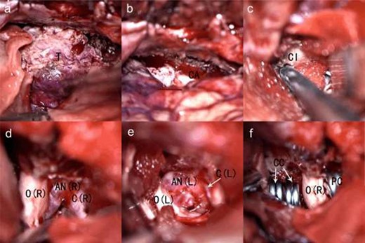 The intraoperative view (a–f). T, tumor; CA, tumor cavity after resection; Cl, clinoid; O(R), right optic nerve; AN (R), right internal carotid artery-ophthalmic segment aneurysms; C(R), right internal carotid artery; O(L), left optic nerve; AN(L), left internal carotid artery-ophthalmic segment aneurysms; C(L), left internal carotid artery; CC, combination of 2 cross—vessel clips; PC, permanent clip.