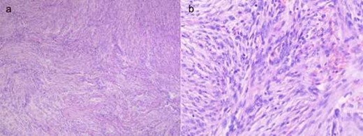 Representative fibroid meningioma shown by hematoxylin and eosin staining. (a) ×40 magnification and (b) ×200 magnification.