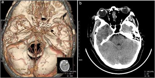Postoperative imaging. Postsurgical CTA revealed that bilateral ophthalmic segment internal carotid artery aneurysms were completely obliterated (a); Postsurgical CT showed postoperative changes in the right temporal bone, swelling of adjacent scalp soft tissues, and slight gas accumulation (b). A, anterior; P, posterior; L, left; R, right.