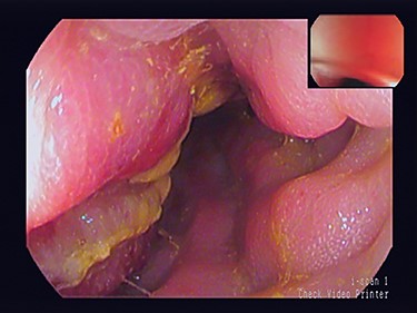 Colonscopic view of sigmoid stricture.