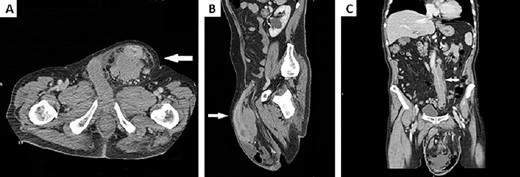 (A) CT scan of the abdomen demonstrated a huge left inguinal hernia containing distal descending colon and sigma (white arrow); (B) CT sagittal scan of the abdomen demonstrated sigma walls thickening inside left inguinal region (white arrow); (C) CT scan of the abdomen showed a bulky adenopathy encircling IMA just below its origin without vessel infiltration (white arrow).