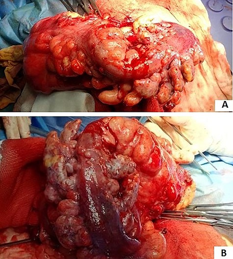 (A and B) sigmoid cancer with epiploic appendix thickening and mesenteric nodules.