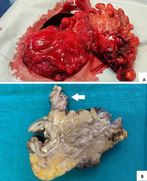 (A and B) surgical specimen view: a hard 7 cm in length sigmoid mass with serosal and epiploic appendix invasion (white arrow).