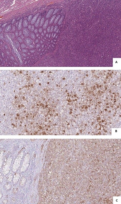 (A) microscopic view showed solid nests, rosette formations, acinar structures, focal necrosis and high mitotic rate; (B and C) immunohistochemistry showed cells positivity for Synaptophysin (A) and Cg A (B).