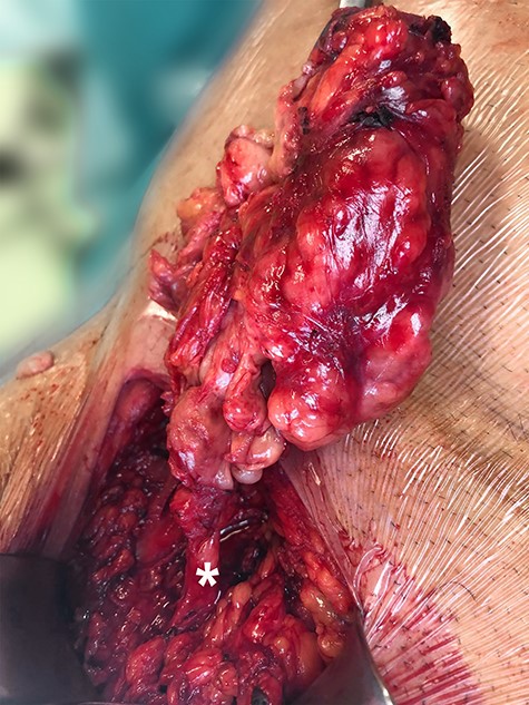Intraoperative image of the mass, with the asterisk depicting the spermatic cord.