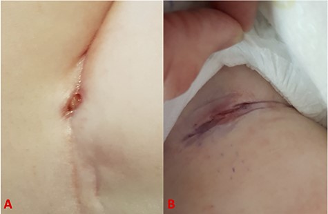 Pictures showing the appearances of the groin wound pre-surgical debridement at 3 months (A) and 9 months (B) after decannulation.
