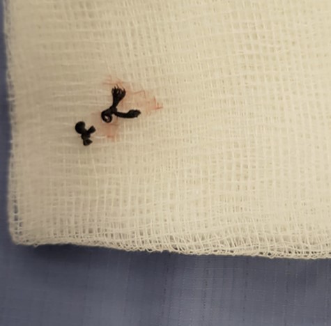A photo of the suture material found at the base of the wound.