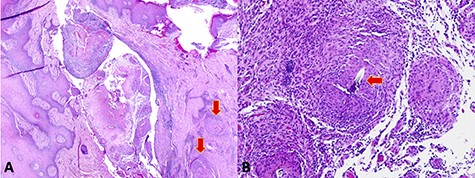 (A) Low-power microscopy image demonstrating a skin tract containing necrotic material and surrounding granulomas (arrows). (B) High-power microscopy image showing suture material embedded in the granulomatous tissue (arrow).