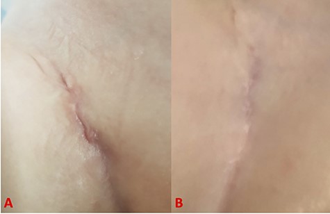 Pictures showing wound healing process at 5 days (A) and 4 months (B) after surgery.