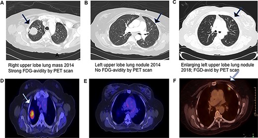 Progression of CT and PET scans between 2014 and 2018, which demonstrates that the left upper lobe nodule initially had no FDG-advidity but subsequently had an interval increase in size and SUV of 7.1.
