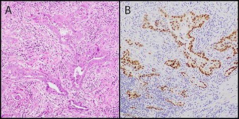 (A) low power image showed adenocarcinoma with angulated acinar architecture in a background of desmoplastic stroma (hematoxylin and eosin stain, original magnification 100×); (B) the tumor cells showed positive nuclear staining for TTF-1 consistent with lung origin (TTF-1 immunostain, original magnification 100×).