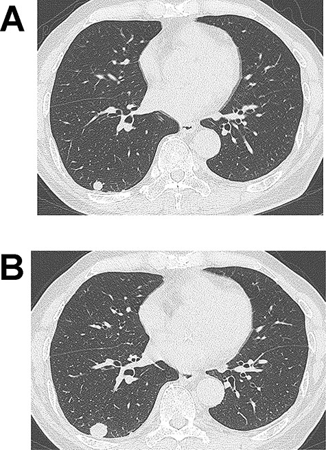 (A) Computed tomography (CT) image showing a 10-mm nodule in the lower lobe of the right lung. (B) The tumour grew to 17 mm in diameter on CT 2 years after the initial imaging.
