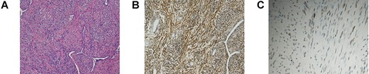 (A) H&E staining of the resected tumour revealed proliferating spindle-shaped cells with a random fascicular arrangement and the deposition of wavy hyalinized collagen. (B, C) Immunohistochemical staining of the tumour. The tumour cells were positive for CD34 (B). Nuclear positivity for STAT6 was observed (C).