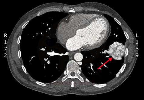 Axial slice from the CTPA, demonstrating the large, complex PAVM in the left lung’s lower lobe (red arrow).