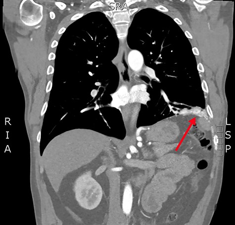 Coronal slice from the CTPA, demonstrating the large, complex PAVM in the left lung’s lower lobe, with some subdiaphragmatic extension (red arrow).
