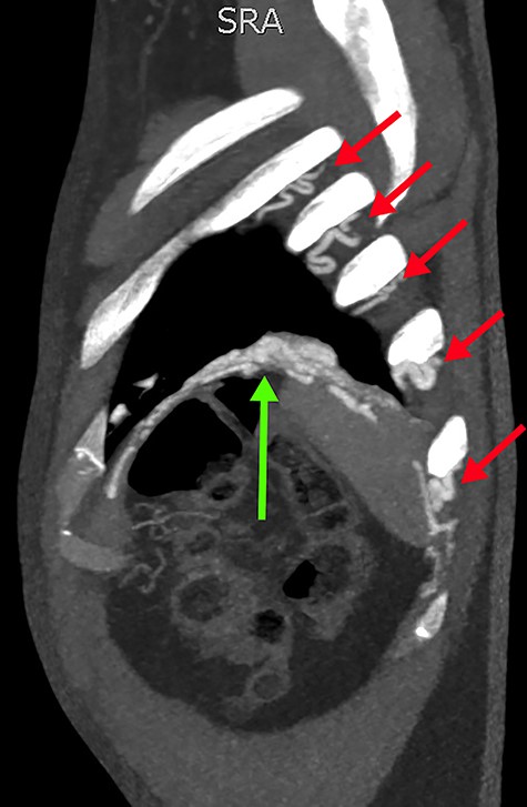 Sagittal slice from the CTPA, demonstrating tortuous intercostal arteries (red arrows) heading towards and feeding the PAVM in the left lung’s lower lobe (green arrow).