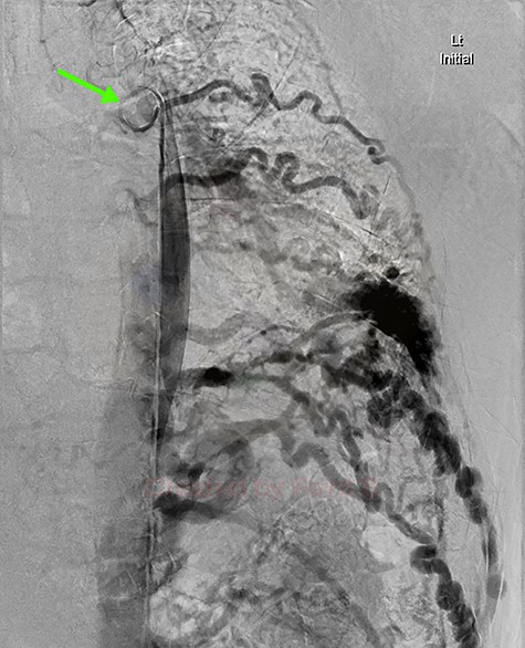 Aortic DSA using a pigtail catheter (green arrow), demonstrating extensive arterial collateralization between the left chest-wall intercostal arteries and the left lower lobe PAVM.