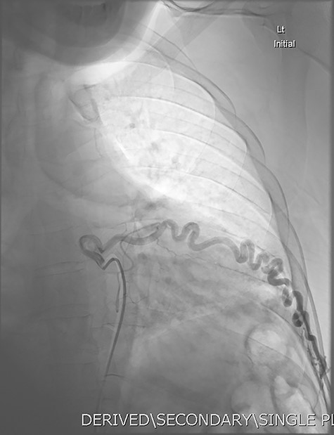DSA utilizing superselective catheterization to demonstrate contribution to the PAVM via one of the many tortuous intercostal arteries.