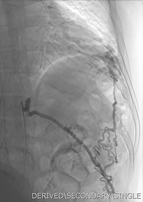 DSA utilizing superselective catheterization to demonstrate contribution to the PAVM via the left inferior phrenic artery, and its extensive subdiaphragmatic collateralization.