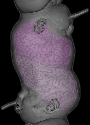 Three-dimensional reconstruction demonstrating total vertical (Type II) craniopagus malformation.