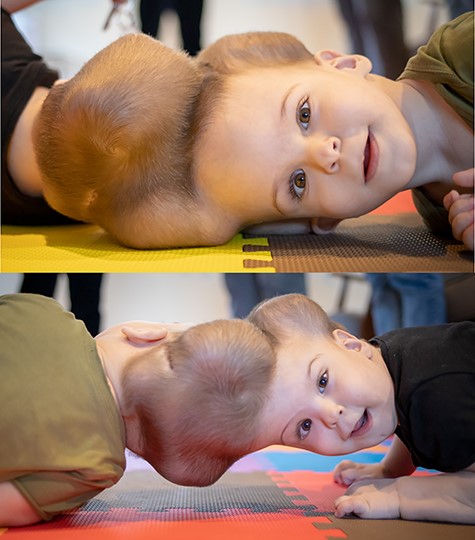 Tissue expansion performed to enable separation and craniofacial reconstruction.