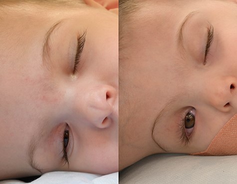 Lagophthalmos appreciated in right eye of both twins under general anaesthesia. Twin 1 (left) displayed right lagophthalmos of 3 mm whereas Twin 2 (right) displayed right lagophthalmos of 6 mm.
