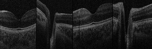 OCT Images. Normal foveae and optic nerve head appearance in both twins, excluding papilloedema. Far-left: Twin 1 normal fovea; centre-left: Twin 1 normal optic nerve head; centre-right: Twin 2 normal fovea; far-right: Twin 2 normal optic nerve head.