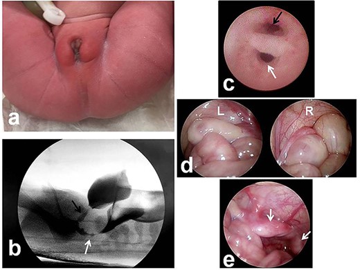 Evaluation of the anorectal and urogenital malformations. (a) External view of the cloacal malformation. (b) Fistulography at 1 day of life shows a cloaca and is suspicious for a vaginal defect (black arrow, urethra; white arrow, rectal fistula). (c) Urethroscopy at 2 months of age reveals two orifices: a urethra and a rectal fistula; there is no vaginal opening (black arrow, urethra; white arrow, rectal fistula). (d, e) Laparoscopy reveals two ovaries and a bicornuate uterus (R, right tube and ovary; L, left tube and ovary; white arrow, bicornuate uterus).