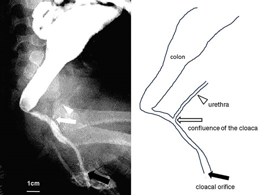 Fistulography and schema of the cloaca, 7 months of age. The common channel is >3 cm in length, and the vagina is defective (black arrow, cloacal orifice; white arrow, confluence of the cloaca; white arrowhead, urethra).