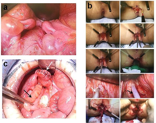 Intraoperative findings during abdominoperineal anoplasty, 11 months of age. (a) Laparotomy confirms the presence of a bicornuate uterus and bilateral ovaries. (b) An inverted Y incision is created at the anal position and the colonic pull-through is performed (white arrow, laparoscopic muscle electrostimulation; black arrow, access needle with radially expandable sleeve). (c) Abdominoperineal anoplasty using the rectal fistula as a neovagina (white arrow, neovagina; black arrow, colonic pull-thorough).