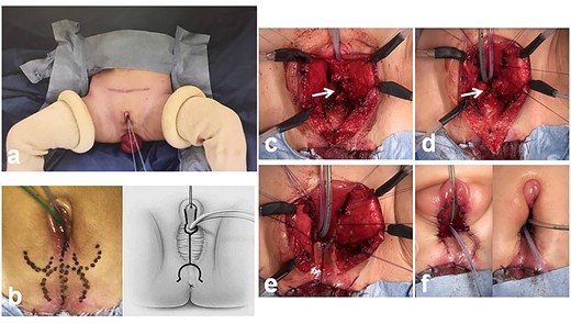 Intraoperative findings during partial urogenital mobilization, 17 months old. (a) Balloon catheters in the bladder and in the rectocutaneous fistula. (b) Surgical planning and initial dissection using a posterior omega flap and a posterior midline incision of the orifice of the cloaca. (c–f) The posterior wall of the persistent urogenital sinus is opened ventrally until the perineal flap is able to reach it. The opened sinus is sewn to the perineal flap. Both sides of the incised sinus are sewn to the skin (white arrow, pubovaginalis muscle at the perineal body).