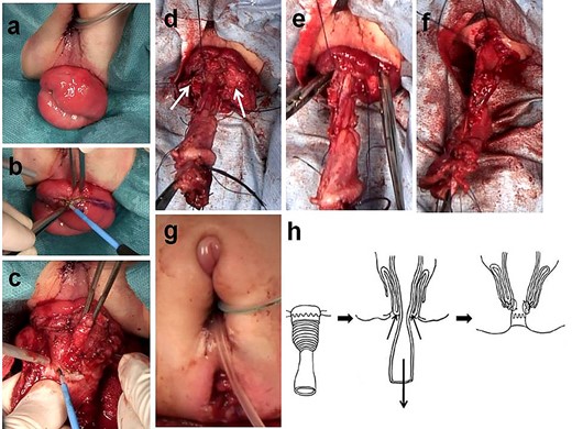 Intraoperative findings during the modified Delorme procedure, 17 months old. (a, b) A circumferential mucosal incision is made ~1 cm from the skin. (c) The mucosal and submucosal layers are dissected from the muscularis layer with the surgeon’s index finger placed in the anal canal. (d) A sleeve of mucosa is dissected, revealing the circular colonic muscular layer up to the vertex of the prolapse (white arrow, circular muscular layer). (e) The exposed circular muscular layer is pushed back through the anal canal. (f) The muscular layer of the colon and the muscle wall of the prolapse are sutured using absorbable material. (g) Completion of partial urogenital mobilization and modified Delorme method. (h) Schematic of the modified Delorme procedure.