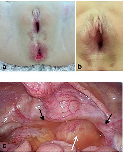 Intraoperative findings during colostomy closure and laparoscopic appendectomy, 22 months old. (a, b) Distinct urethral and vaginal openings are not able to be recognized. (c) The stump of the rectal fistula (now the neovagina), a bicornuate uterus and two ovaries are recognized (black arrows, ovaries; white arrow, neovagina).