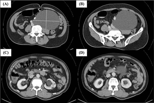Representative CT images of the retroperitoneal lymphangioma. (A) Well-circumscribed hypodense structure in the left side of the retroperitoneum adjacent to the aorta, left common iliac artery and left common iliac vein measuring ~13 cm × 9.7 cm × 15.8 cm. There is no significant thickened septation or mural nodularity. (B) The left common iliac artery is displaced anteriorly. (C and D) There is mild mass effect resulting in mild dilatation of the left renal pelvicaliceal system and upper ureter. Both kidneys show symmetrical enhancement and renal cortex is of satisfactory thickness.