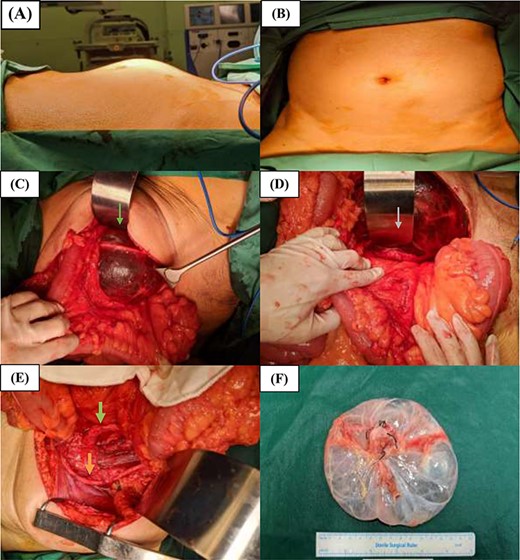 Preoperative and intraoperative photographs of the retroperitoneal cystic tumour. (A) Right lateral and (B) top-down preoperative views of the abdomen demonstrating the palpable left iliac fossa mass. (C and D) Intraoperative views of the retroperitoneal cystic mass with the left common iliac artery identified (grey arrow) and left ureter (green arrow) overlying the mass. (E) The left common iliac artery (grey arrow) and left ureter (green arrow) can be clearly seen and are preserved intact following resection of the retroperitoneal cystic mass. (F) Photograph of the retroperitoneal cystic mass specimen.