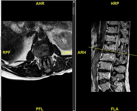 Initial MRI images prior to index procedure revealing stenosis at L1/2 and L2/3.