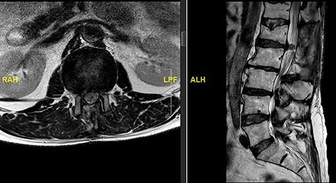MRI image revealing a recurrence of a disc prolapse, suspected to be an intradural disc at L1/2, confirmed intraoperatively.