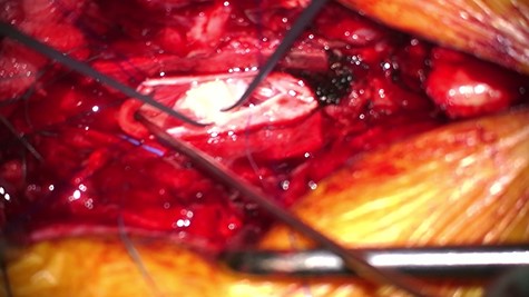 Intraoperative picture showing durotomy and intradural disc being delivered at L1/2.