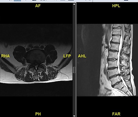 Preoperative MRI scan showing L4/5 disc prolapse.