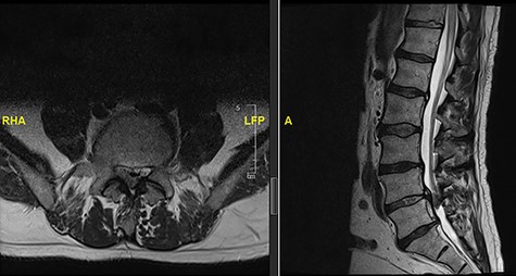 MRI scan showing an intradural disc at L4/5.