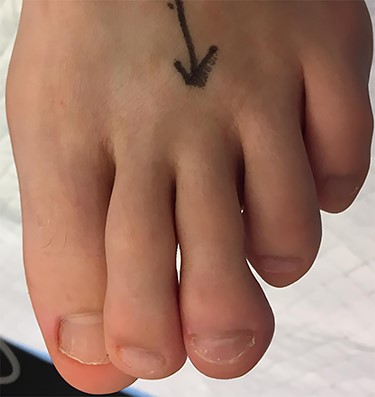 Enlargement of the distal phalanx of the third left toe and its nail.